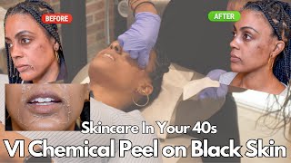 How To Treat Hyperpigmentation and Dark Spots on Black Skin Using A VI Precision Plus Chemical Peel [upl. by Correy]