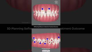 Correction of Gaps in Teeth with Invisalign Braces  Invisalign Kolkata invisalign clearaligner [upl. by Baun]