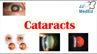 Cataracts  Causes Risk factors Subtypes Cortical Nuclear Posterior subcapsular Treatment [upl. by Mickey]