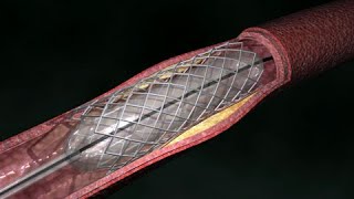 Coronary Artery Angioplasty  Radial Access [upl. by Sawtelle]