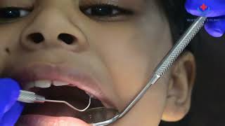 How to Help Your Child with Cavity Fillings  Tips for Parents [upl. by Hanikehs]