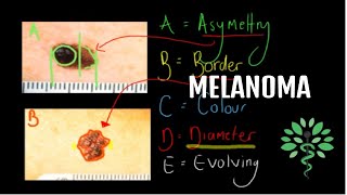 Melanoma  Symptoms signs diagnosis and management [upl. by Einnaffit]