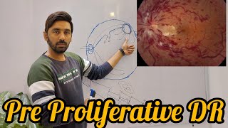 Pre Proliferative diabetic retinopathy [upl. by Ttelracs]