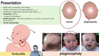 Fibromatosis Colli  pediatric ultrasound  DrMohamed Soliman [upl. by Idnil]