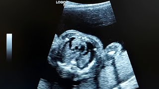 obstetric ultrasound shows isolated bilateral fetal pleural effusions FPE [upl. by Vil]