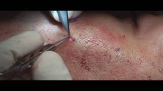 Acne Scar Revision Part 04 More Subcision Technique by Dr Young [upl. by Kayne]