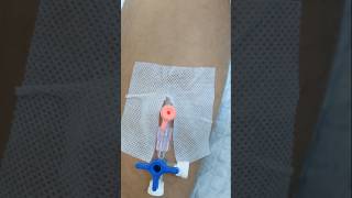 IV Cannulation cannula subscribe hospital cannulainsertion shortsindia [upl. by Klug]