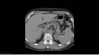 Pancreatite crônica calcificante [upl. by Hareemas912]