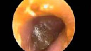 Acute Otitis media tympanic blister [upl. by Anitserp]