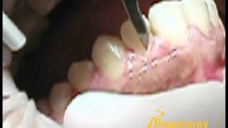 How to do a Fiberotomy Powerprox Six Month Braces Orthodontic Education Video [upl. by Lika236]