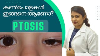 Ptosis health rovinhome ptosiscorrection ptosis eyelid eyepower malayalam optometrists [upl. by Alenas]