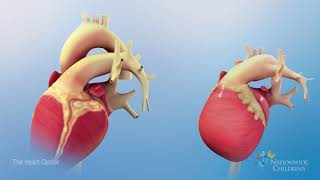 Normal Heart Anatomy vs Hypoplastic Left Heart Syndrome HLHS Anatomy [upl. by Niki]