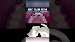 FIRST ORDER BENDS  ORTHODONTIC TIPS Shorts [upl. by Parthenia]