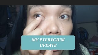 my Pterygium surgery update  beverlylayug [upl. by Desi]