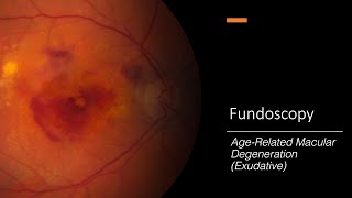 AgeRelated Macular Degeneration Exudative Fundoscopy [upl. by Ambrosane119]