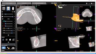 Tutorial CS 3D imaging software 12Carestream Corte Oblicuo amp zoom 3Davi [upl. by Nangatrad]