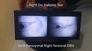 Apogeotropic Left Posterior Semicircular Canal BPPV [upl. by Naes]