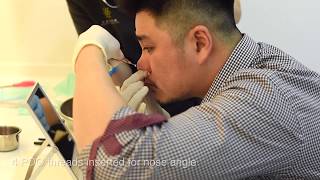 Nose Thread Lift See How It Is Done Dr Siew Tuck Wah Performs Nose Thread Lift On Himself [upl. by Esilehs642]