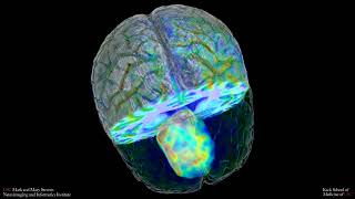 T1 brain with tumor perfusion volume [upl. by Enyalaj]