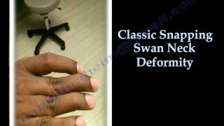 Swan Neck Deformity Classic Snapping  Everything You Need To Know  Dr Nabil Ebraheim [upl. by Yraillih287]