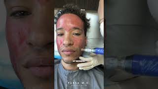 Microneedling with PRP for Acne Scars  Kami Parsa MD skincare acnescars [upl. by Frangos]