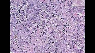 Histopathology LungBlastomycosis [upl. by Assiram]