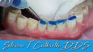 Bonding Worn Anterior Teeth  Dental Minute with Dr Steven T Cutbirth DDS [upl. by Agamemnon377]