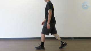 Amputee Trendelenburg Gait  Case Study 27 [upl. by Tootsie]