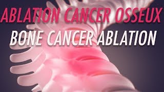 Ablation de metastases osseuses  Interventional Therapy for metastatic bone disease [upl. by Elfstan]