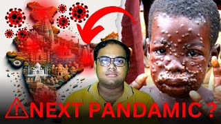 NEXT PANDAMIC Monkey Pox Signs amp Symptoms monkeypox mpox reetmukherjee [upl. by Amero]