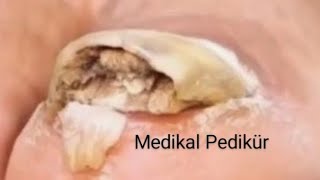 CLİNİQUE PEDİCURE 👣 Ayak SağlığıTırnak BatmasıNasırTopuk ÇatlağıDiyabetik Ayak SağlığıMantar [upl. by Pedaiah656]