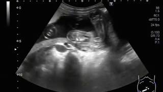 Ultrasound Video showing Fetal ascites and pericardial effusion [upl. by Murtagh]