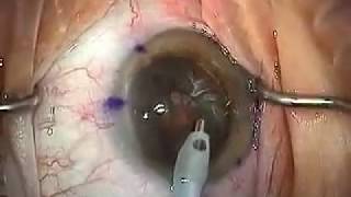 Modern Cataract Surgery Alcon ReSTOR IOL with LRI [upl. by Nediarb]