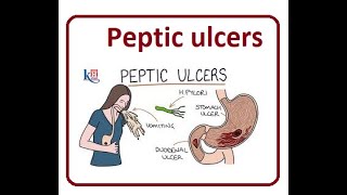 Peptic Ulcers Causes Symptoms  2024 [upl. by Sirac]