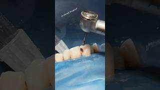 Cavity liner and composite restoration satisfying asmr [upl. by Melborn56]