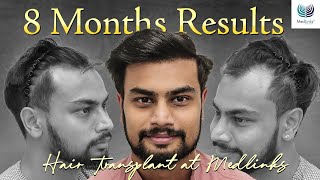 Amazing 8 Months Hair Transplant Results  Patient Experience with Dr Gaurang Krishna [upl. by Barber]