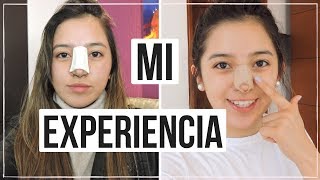 Mi Experiencia Cirugía de Nariz Mariewithem [upl. by Ailina]