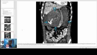 Hepatic Adenoma Imaging [upl. by Emerick928]