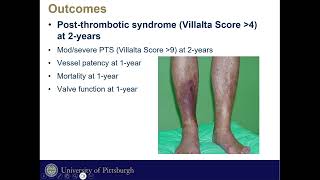 Post Thrombotic Syndrome Morbidity In Mechanical Thrombectomy Vs CDT of Iliofemoral DVT [upl. by Goran46]