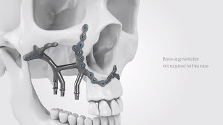 IPS Implants® Preprosthetic  Treatment workflow [upl. by Ribal]