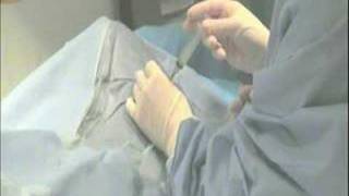 Radiofrequency Ablation of an Osteoid Osteoma [upl. by Kcirddehs405]