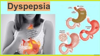 Dyspepsia  Functional Dyspepsia  Organic Dyspepsia Heart Burn Hindi  UrduTडिस्पेप्सिया [upl. by Arreis939]