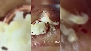 Satisfying Blackhead Removal Clear Skin Transformation Part 01 [upl. by Alyn297]