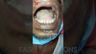 Tongue Fasciculations  Motor Neuron Disease  Dr Shankar Dey [upl. by Amalberga]