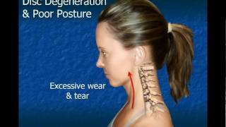 Cervical Disc Degeneration [upl. by Serles884]