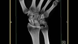 Wrist Anatomy Healing fracture of the scaphoid with a small cyst 1 of 2 [upl. by Dloreh]