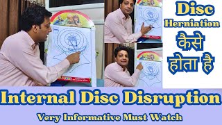 Internal Disc Disruption  Mechanism Behind Disc Herniation  Dr Rajesh Sharma PT [upl. by Helm616]