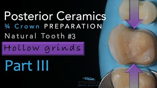 Zirconia Ceramics Part 3 ThreeQuarter Crown Preparation  Using Hollow Grind [upl. by Ynohtnacram945]