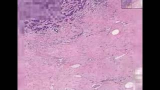 Histopathology Breast Ductal carcinoma [upl. by Arhoz]