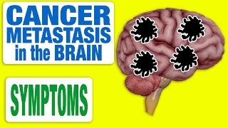 Cancer Metastasis in the Brain  All Symptoms [upl. by Morehouse441]